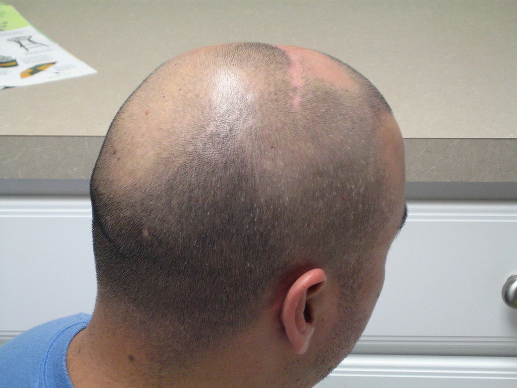 Hair loss